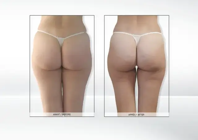 Endermologia: Ile cm stracisz? Realne efekty i wskazówki