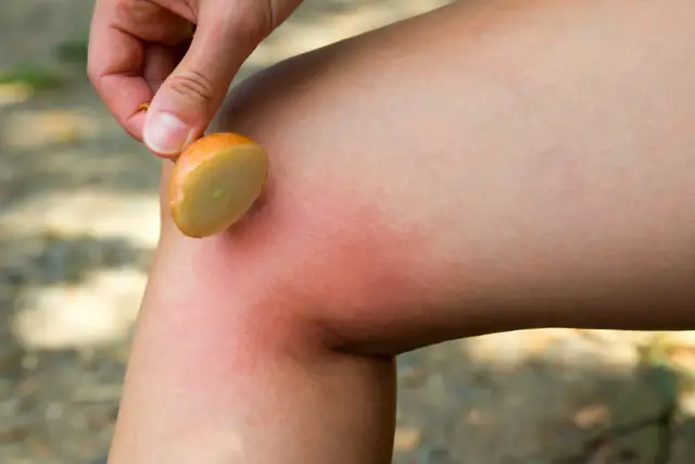 Użądlenie osy: Szybka pomoc, domowe sposoby i objawy alergii