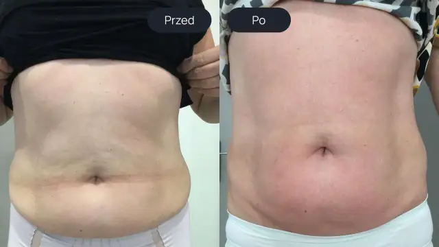 Porównanie brzucha przed i po zabiegu endermologii.