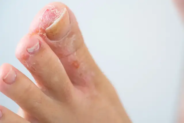 Skóra między palcami u nóg jest zaczerwieniona i łuszcząca się, co wskazuje na rany między palcami u nóg.