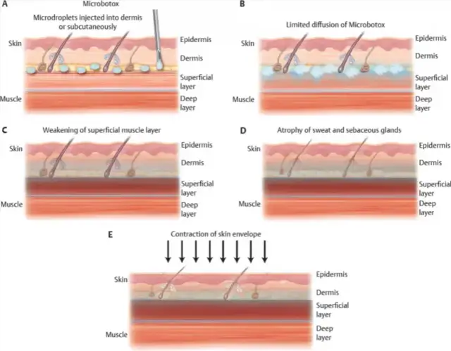 Jak działa botox? Poznaj mechanizm i skutki jego działania