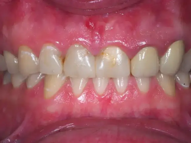 Podrażnione dziąsła: Szybka ulga i trwałe rozwiązanie. Kiedy do dentysty?