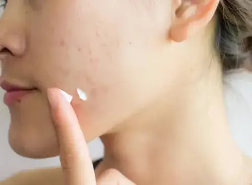 Czy pasta do zębów pomaga na pryszcze? Ryzyko i skuteczność stosowania