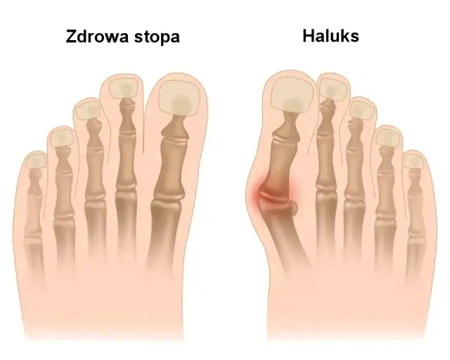 Czy to haluks? Zobacz, jak rozpoznać paluch koślawy na stopie