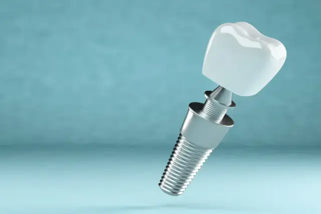 Odrzucenie implantu zęba po jakim czasie? Poznaj kluczowe czynniki