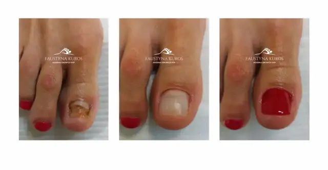 Uszkodzony paznokieć: Jak skutecznie go zregenerować i odbudować?