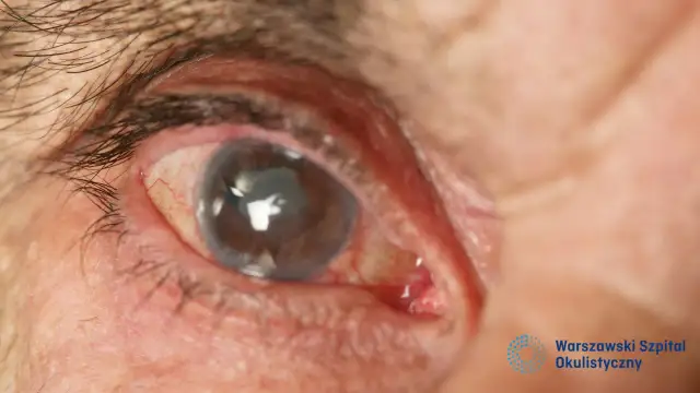 Jaskra: Przyczyny, objawy. Jak rozpoznać i chronić swój wzrok?