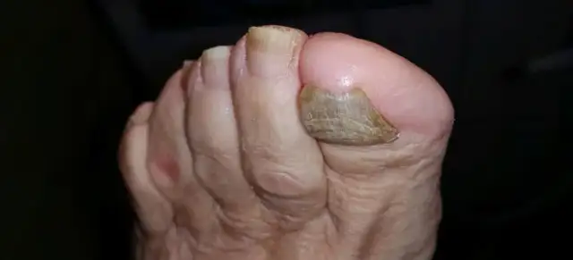 Jak wygląda stopa cukrzycowa? Objawy, zmiany i co powinieneś wiedzieć