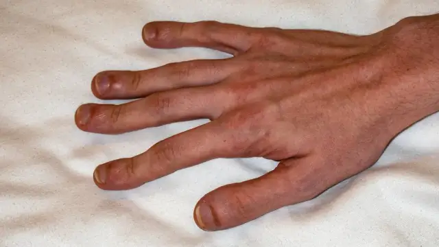 Krzywe palce u rąk: Zdjęcia, przyczyny i skutki deformacji