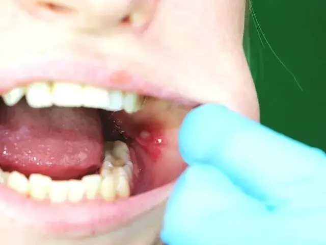 Afta na dziąśle objawy: poznaj ból i dyskomfort, które mogą zaskoczyć