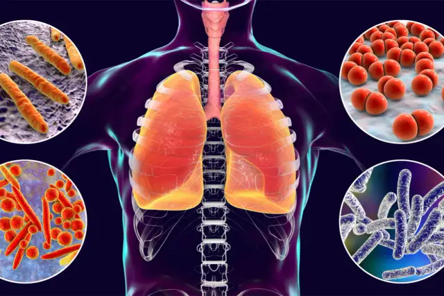 Płuca człowieka i różne bakterie, które mogą powodować chorobę legionistów, często związane z klimatyzacją.
