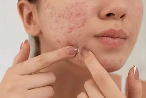 Jak szybko zagoić rozdrapany pryszcz i uniknąć blizn?