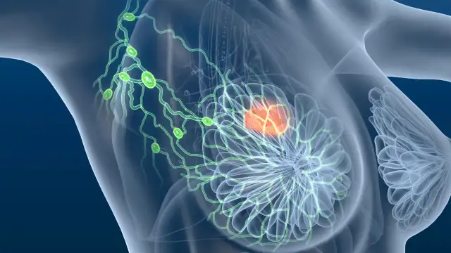 Schemat układu limfatycznego piersi z widocznymi wezłami chłonnymi pachy i zmianą nowotworową.