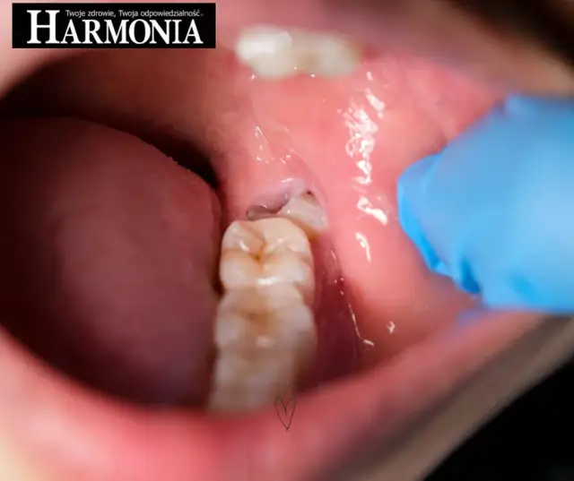 Grzybica dziąseł: objawy, leczenie i zapobieganie. Poznaj fakty!