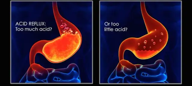 Niedokwaśność żołądka objawy – poznaj, co może ci dolegać