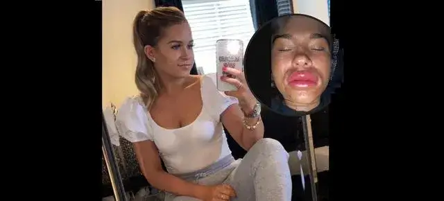 Czy można pić alkohol po powiększeniu ust? Poznaj zalecenia