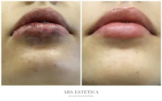 Alergia na kwas hialuronowy? Co naprawdę uczula i jak się chronić?