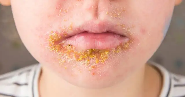 Liszaj w jamie ustnej: Jak skutecznie leczyć i kontrolować objawy?