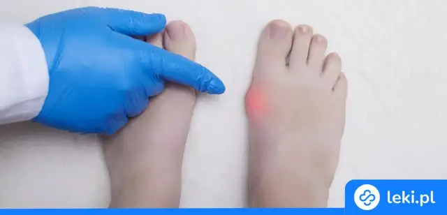 Haluksy: Skuteczna ulga w bólu? Poznaj wszystkie metody!