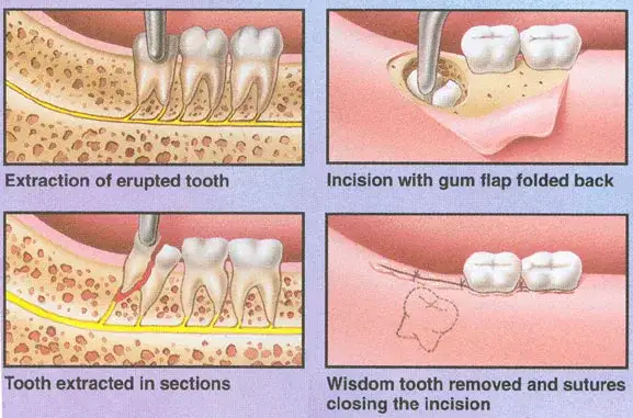 Co dentysta robi z wyrwanym zębem? Szokujące fakty i procedury
