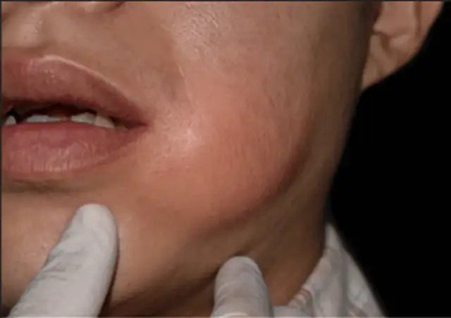 Ropień zęba: Jak szybko złagodzić ból i uniknąć powikłań?