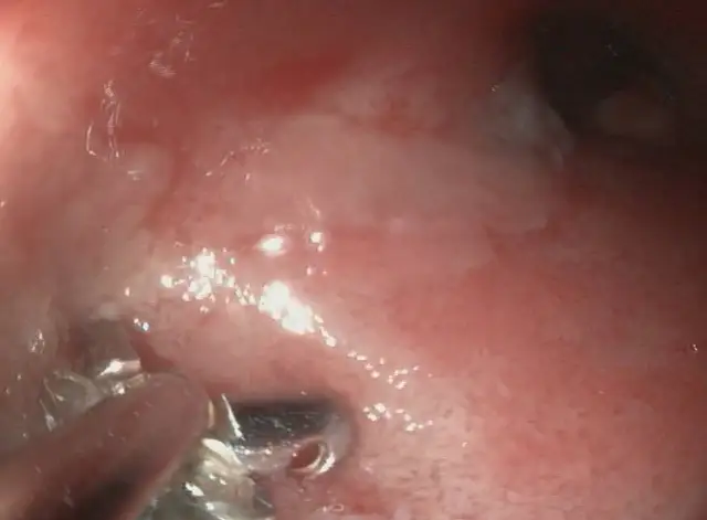 Widok endoskopowy jelita kota z objawami IBD. Widoczne zaczerwienienie i zmiany zapalne.