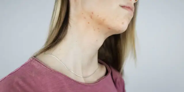 Pryszcze na szyi: Przyczyny, skuteczne sposoby i kiedy do dermatologa?