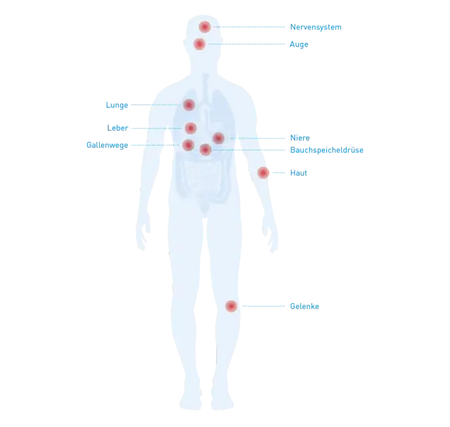 Morbus Crohn: Diese Medikamente unbedingt meiden (Ärzte-Tipps)
