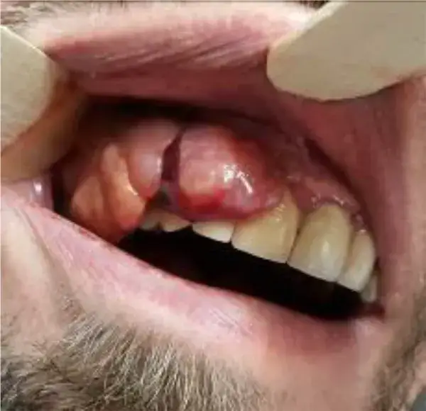 Czerniak jamy ustnej objawy – jak je rozpoznać i nie przegapić