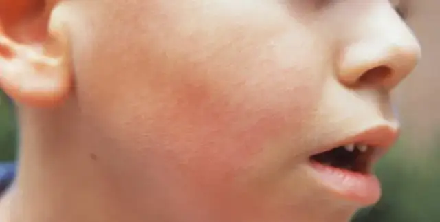 Rumień zakaźny kiedy do przedszkola? Kluczowe informacje dla rodziców