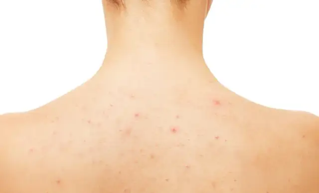 Pryszcze na plecach: Jak się ich pozbyć? Kompleksowy poradnik