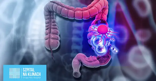 Chirurgia kolorektalna: Co to jest i jak leczy?