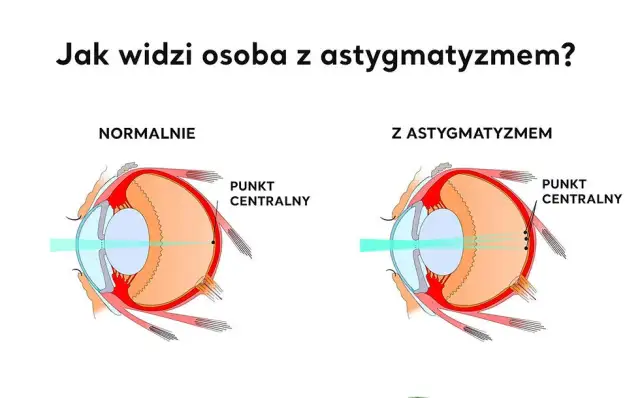 Jakie są wady wzroku? Poznaj objawy i skuteczne leczenie