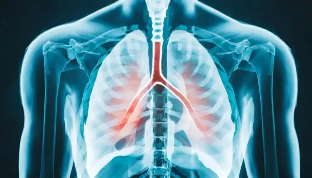 Skuteczne leki na zapalenie płuc: bezpieczne metody leczenia i kuracji