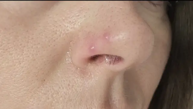 Pryszcz na nosie: Jak usunąć bezpiecznie i czego unikać?