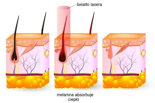 Depilacja laserowa: Jak działa? Laser czy IPL? Wybierz mądrze!