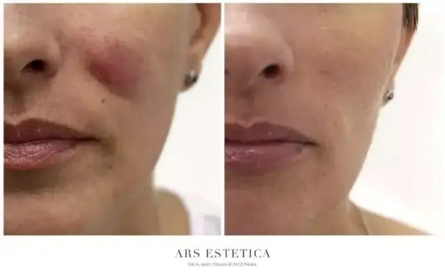 Opuchlizna po kwasie hialuronowym? Szybka ulga i sprawdzone triki