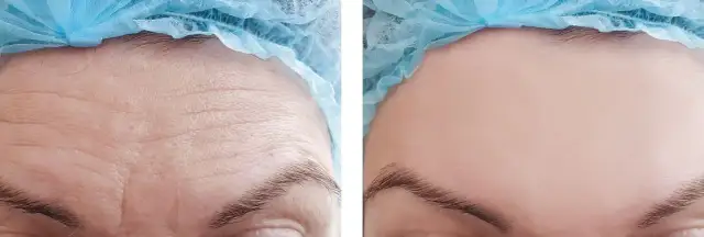 Lwia zmarszczka: botoks czy kwas hialuronowy – co naprawdę działa?