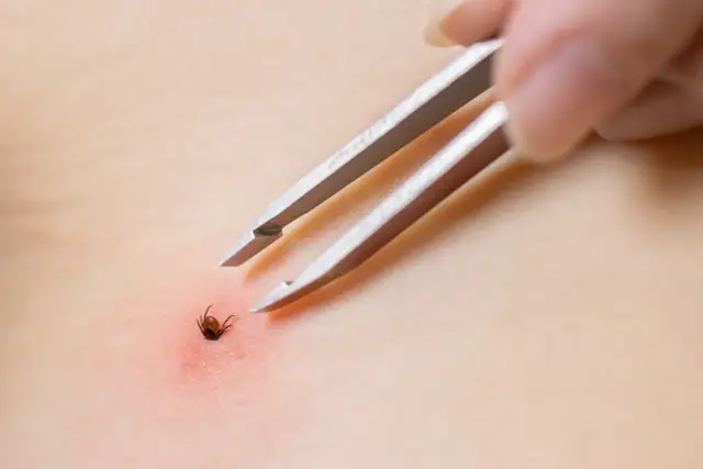 Urwał się kleszcz? Jak bezpiecznie usunąć resztki z ciała.