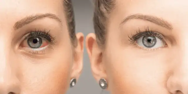 Jak wygląda jaskra w oku? Objawy, które mogą zaskoczyć każdego