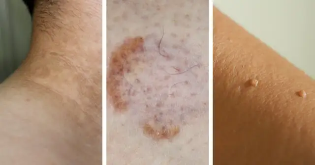 Cukrzyca: psychiczne objawy, które musisz znać. Jak sobie radzić?