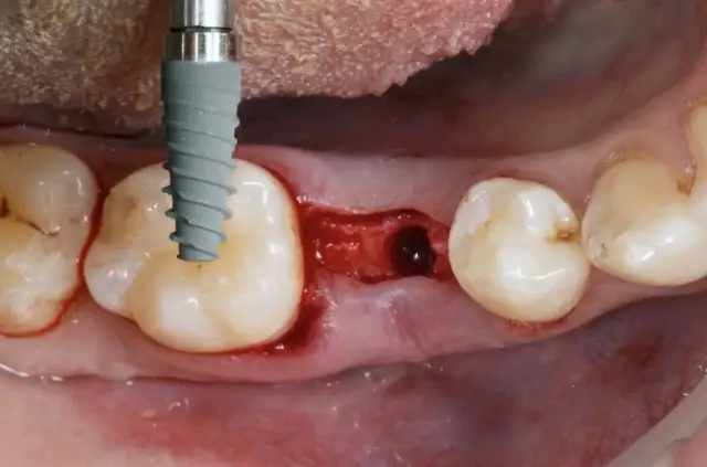 Kiedy implant po wyrwaniu zęba? Poznaj kluczowe terminy i ryzyka