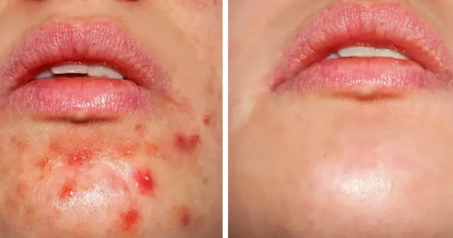 Czy kwas salicylowy się zmywa? Ekspert radzi, jak go stosować