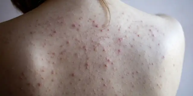 Co na pryszcze na plecach? Skuteczne sposoby i leczenie bacne
