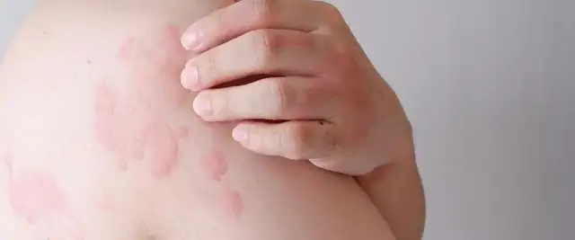 Alergia pokarmowa u dorosłych: objawy skórne, diagnoza, leczenie