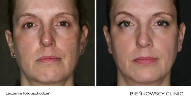 Jak pozbyć się przebarwień? Przewodnik do jednolitej cery!