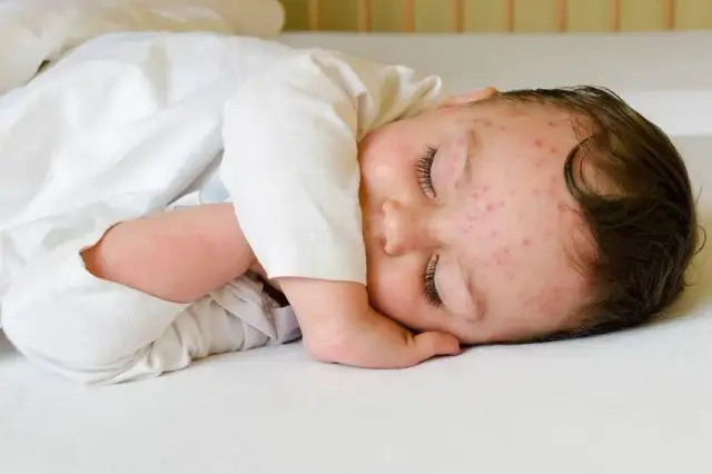 Kiedy wyjść z dzieckiem po ospie? Kluczowe informacje dla rodziców