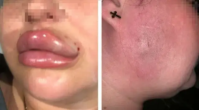 Co na opuchliznę ust po kwasie hialuronowym? Skuteczne metody łagodzenia bólu