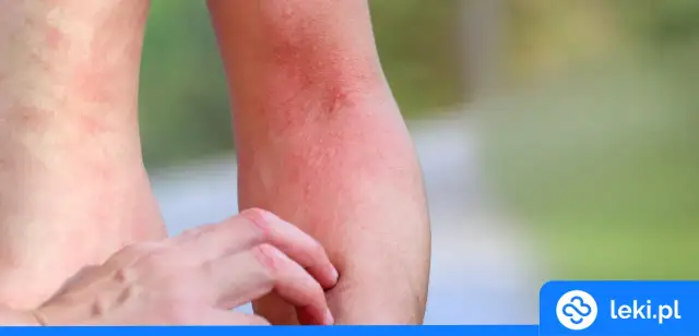 Alergia na leki: Rozpoznaj objawy i działaj! Poradnik krok po kroku