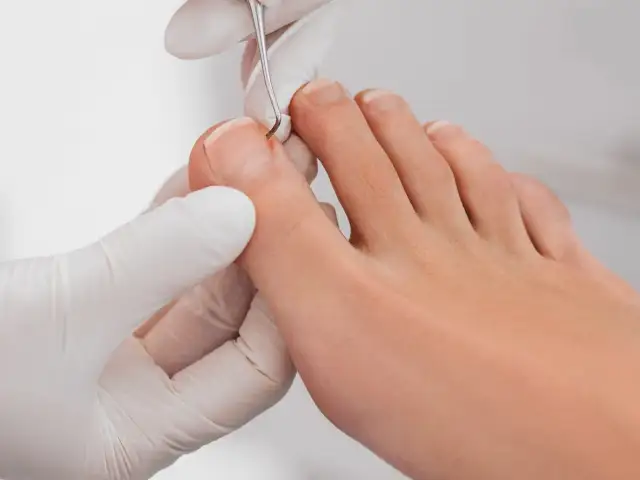 Jak zrobić tamponadę paznokcia? Ulga od wrastania krok po kroku